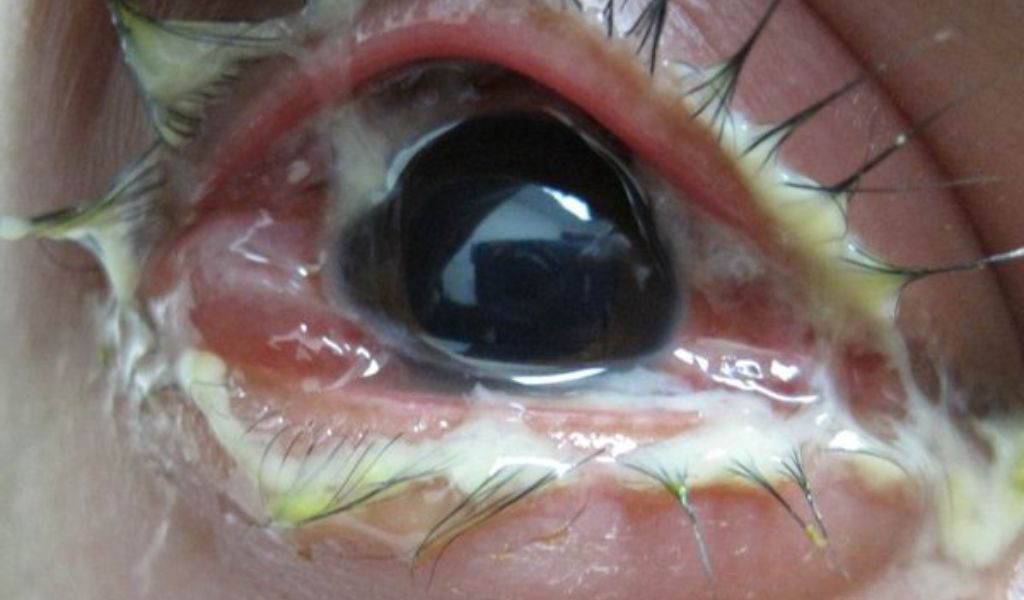 Vi khuẩn Neisseria gonorrhoeae gây nên viêm kết mạc do lậu