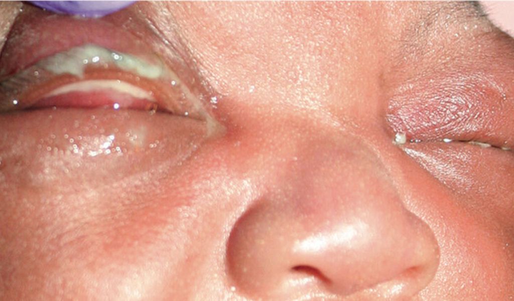 Ở trẻ sơ sinh, triệu chứng xuất hiện sau 2 - 5 ngày và gây tổn thương giác mạc nếu chậm điều trị