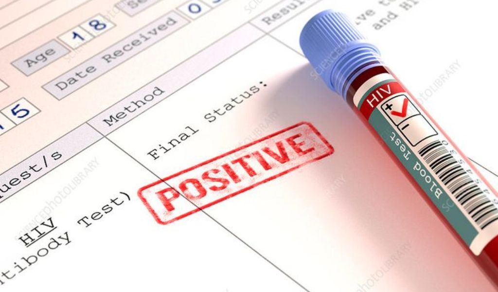 Cách đọc kết quả xét nghiệm HIV dễ dàng và chính xác 2
