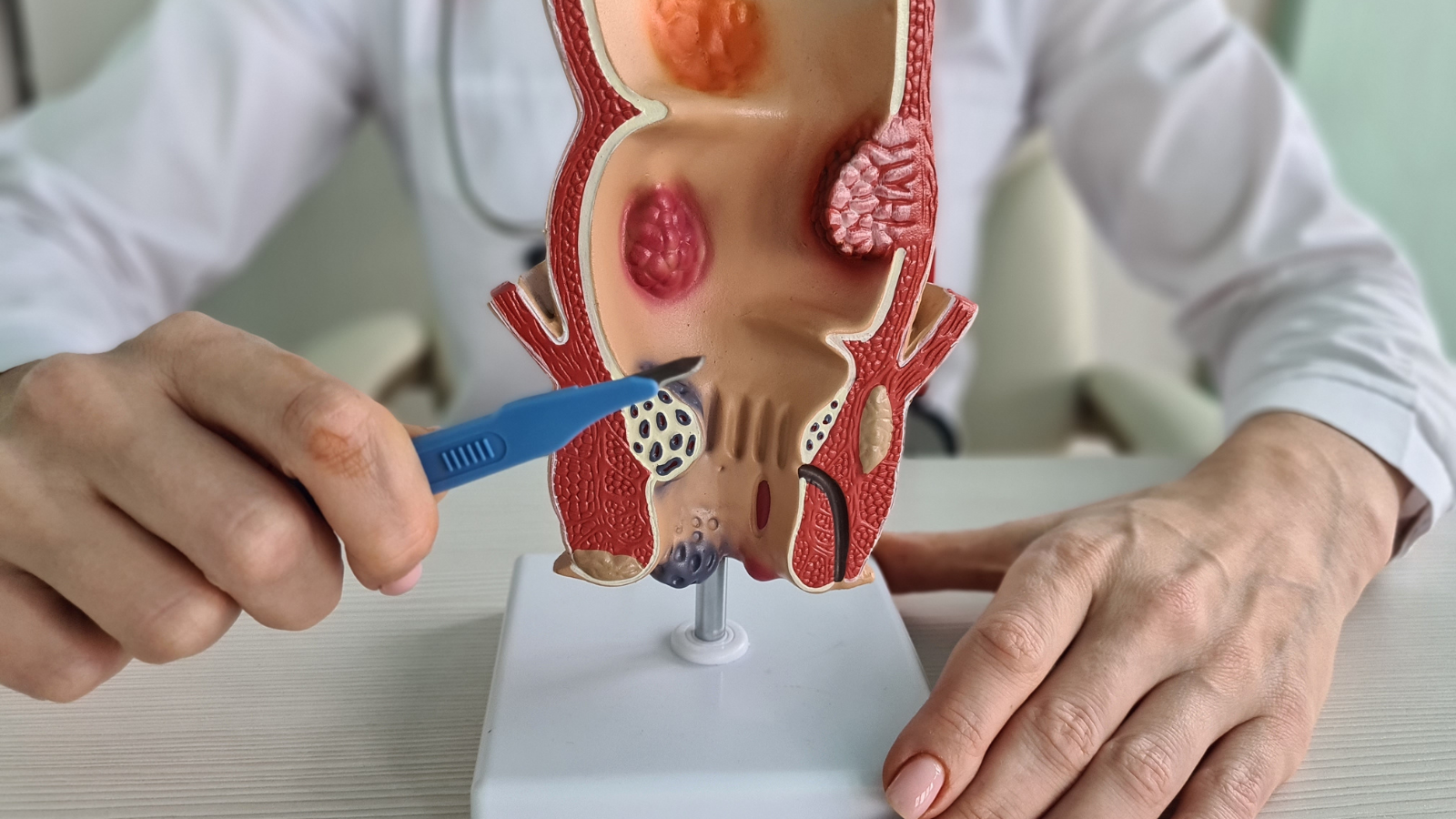Mổ trĩ xong nên ăn gì để nhanh hồi phục?