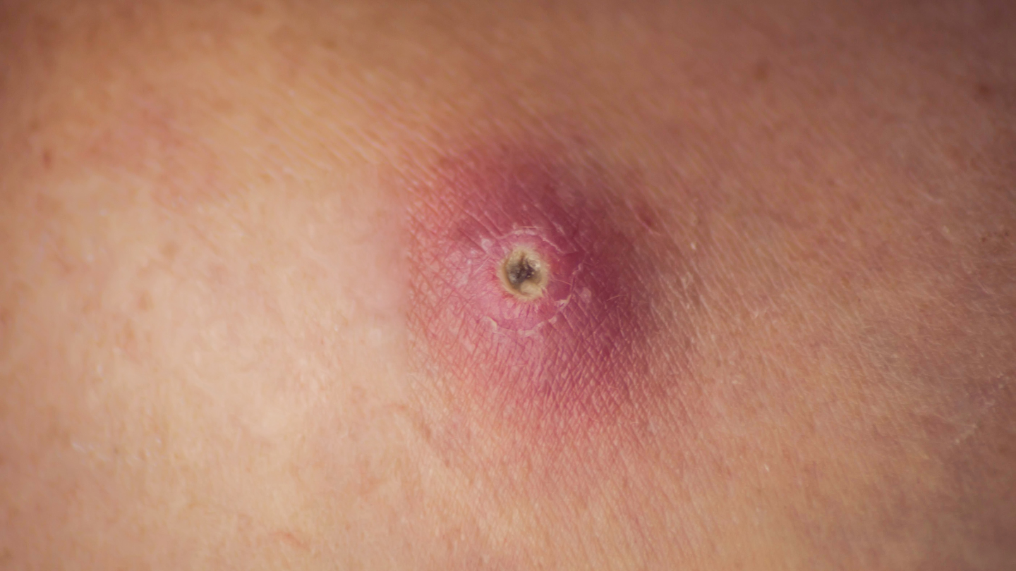 Vết thương áp xe bao lâu thì lành là câu hỏi được nhiều người đặt ra