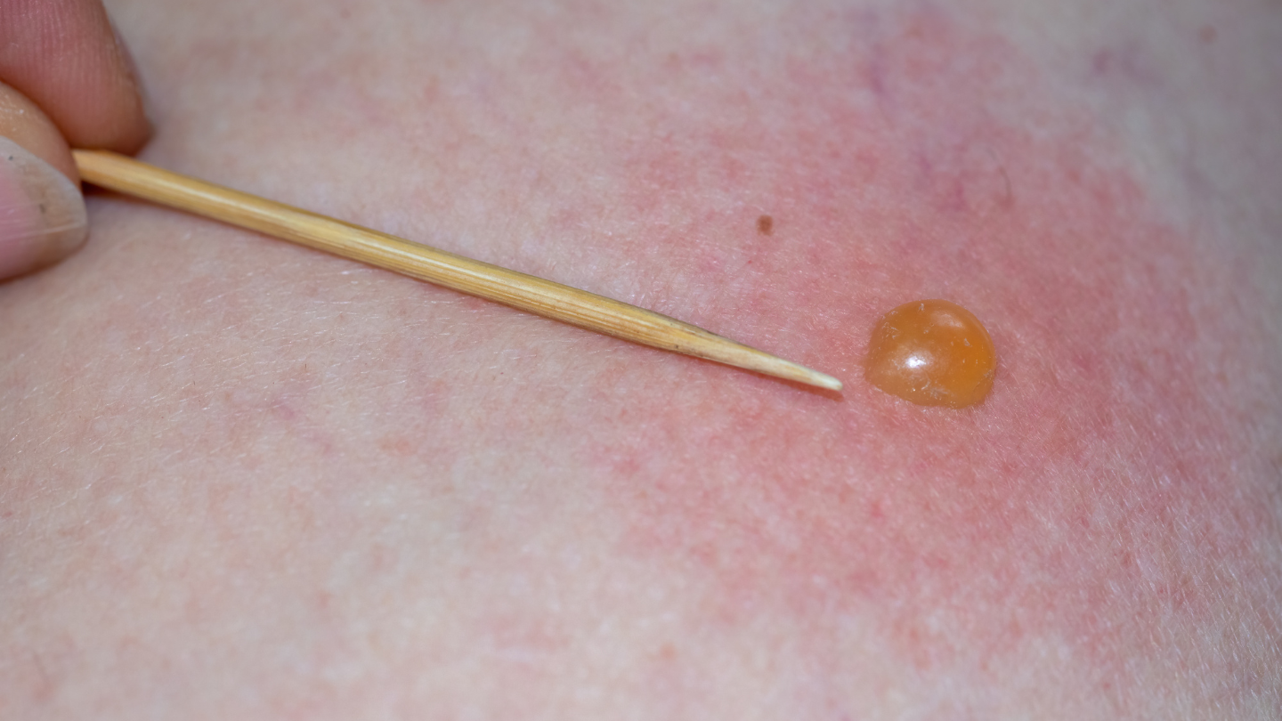 Vết côn trùng cắn bị bóng nước có nguy hiểm không?