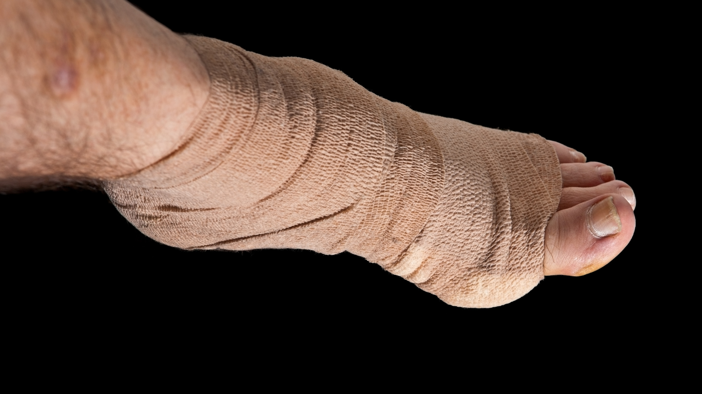 Gãy xương bàn chân bao lâu hết sưng là thắc mắc của nhiều người đặt ra