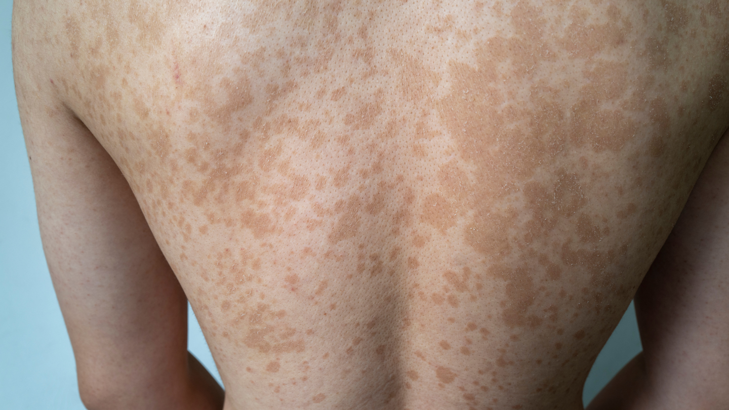 Lang ben là một tình trạng nhiễm nấm da không ngứa