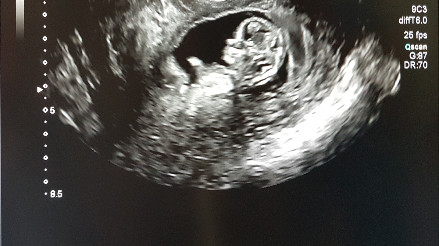 Xét nghiệm sàng lọc 3 tháng đầu bao nhiêu tiền là câu hỏi được đặt ra bởi nhiều mẹ bầu