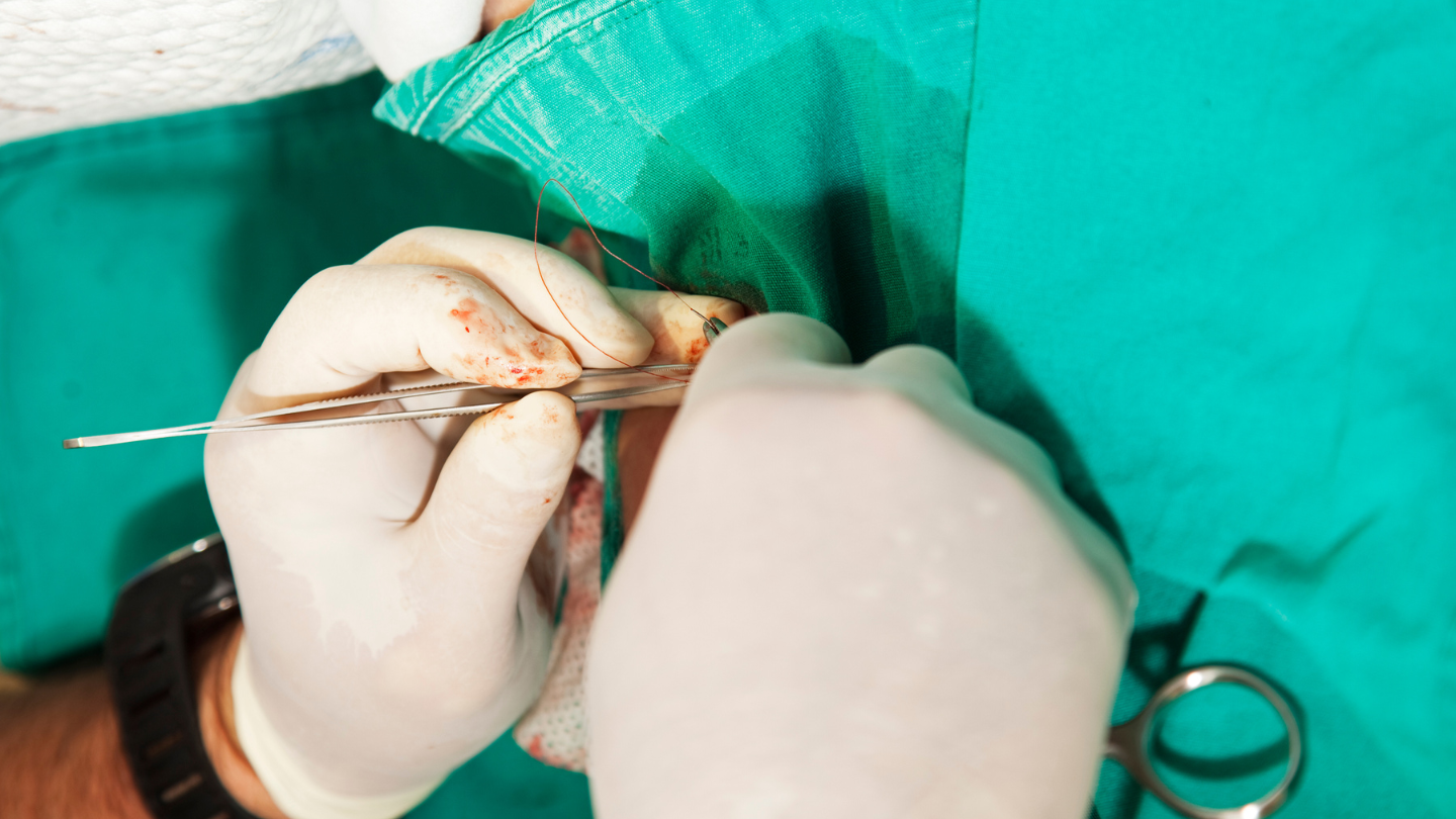 Cắt bao quy đầu có đau không là câu hỏi được nhiều bạn nam đặt ra