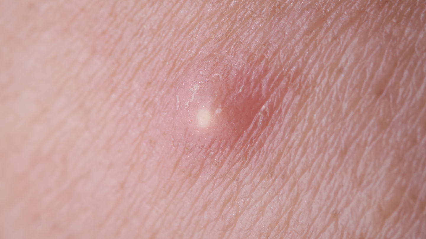 Mụn nhọt ở cổ có nguy hiểm không là thắc mắc của nhiều người khi gặp tình trạng này