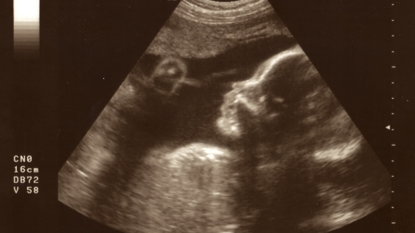 "Thai 34 tuần nặng 2kg có nhỏ không?" là thắc mắc của nhiều mẹ bầu