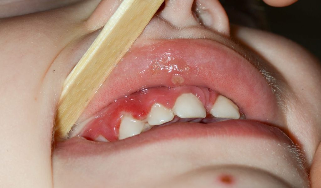 Nướu bị tổn thương có thể khiến trẻ bị hôi miệng chảy máu chân răng