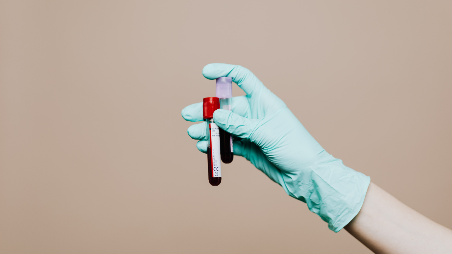 Xét nghiệm HIV AB test nhanh có chính xác không là câu hỏi của nhiều người đặt ra