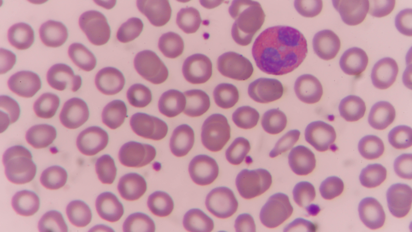 Tỷ lệ bạch cầu lympho tăng là gì?