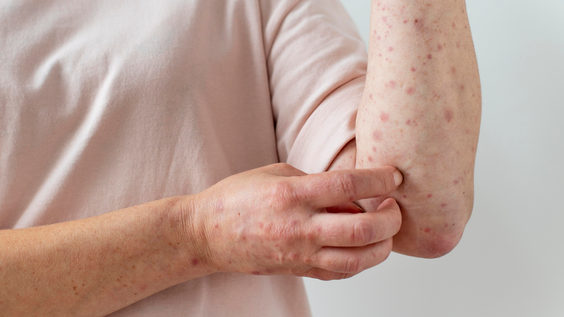 benh-thuy-dau-va-bien-hien-cua-not-thuy-dau-2