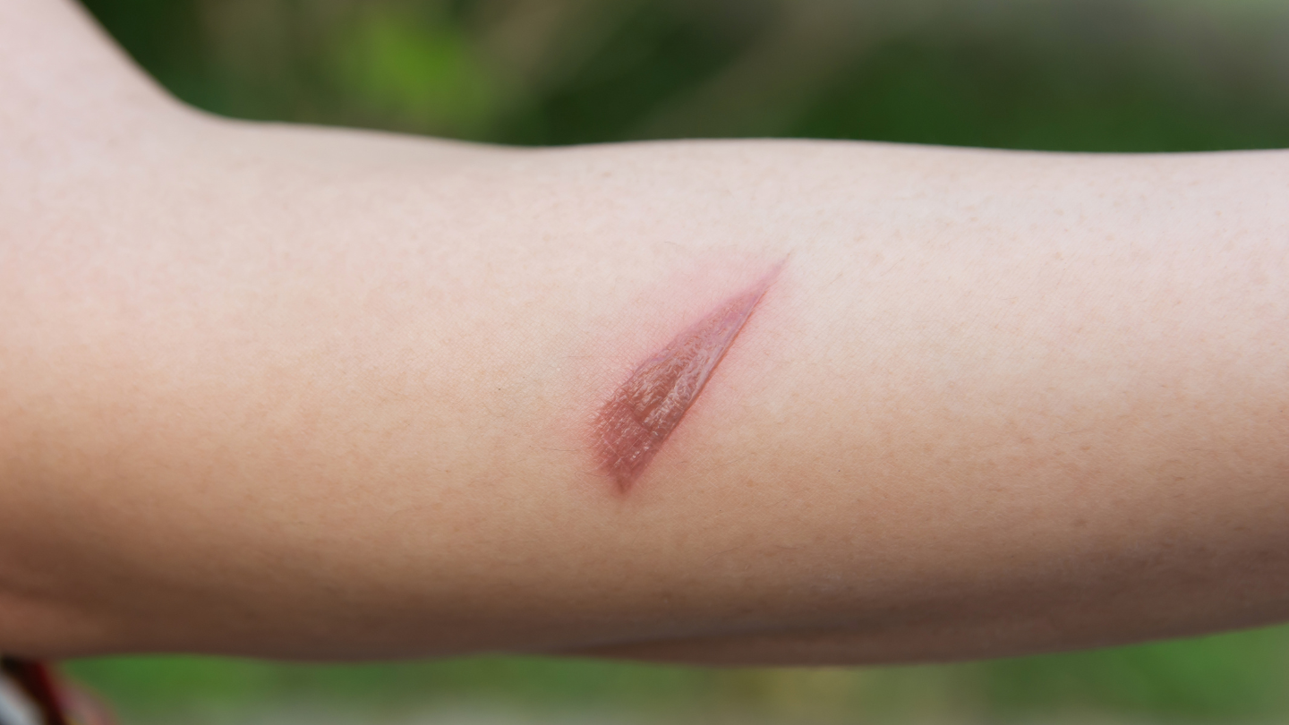 Vết thương đã lành nhưng vẫn đau có bình thường không?