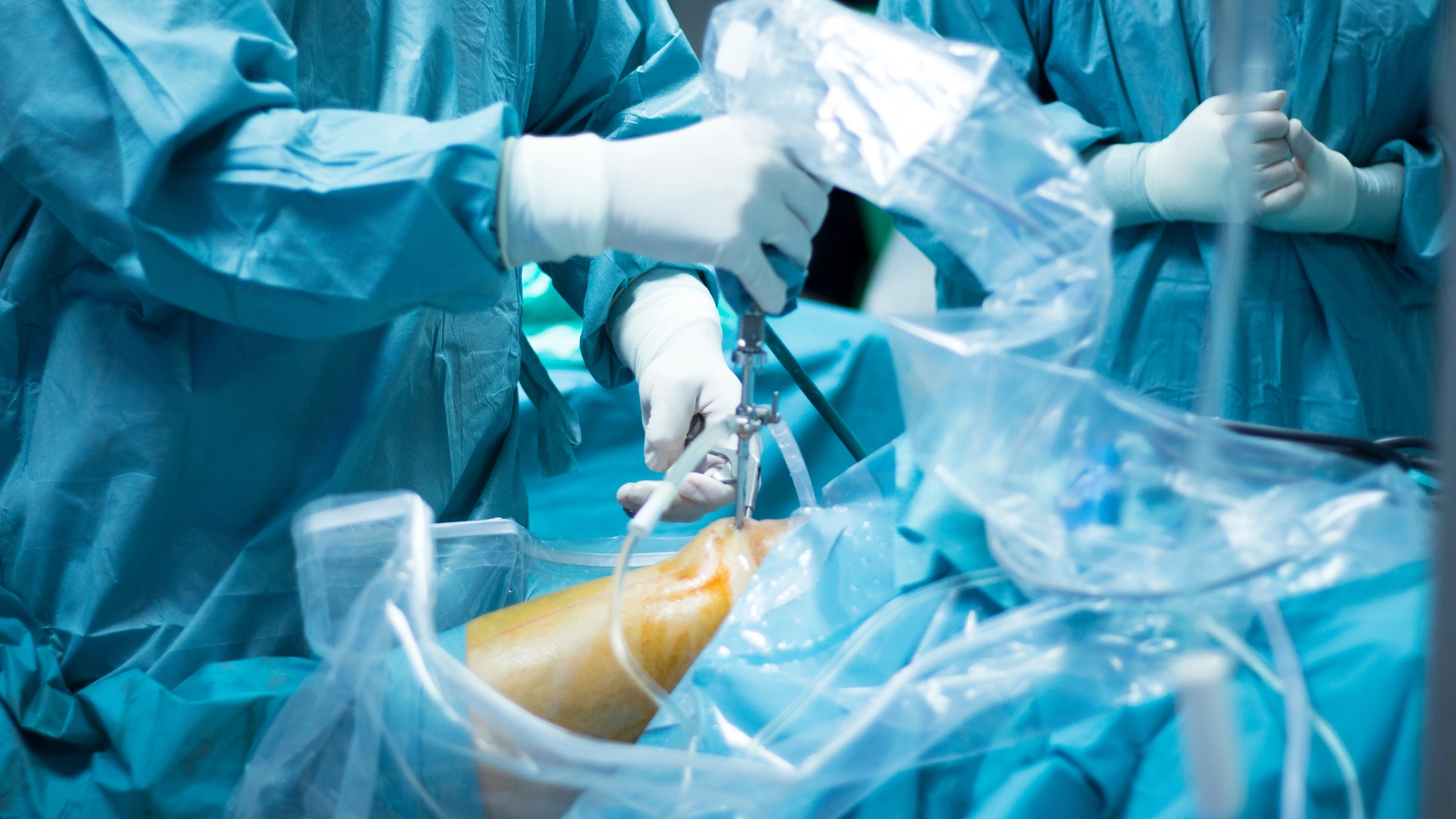 Phẫu thuật kéo dài chi nên được cân nhắc thận trọng