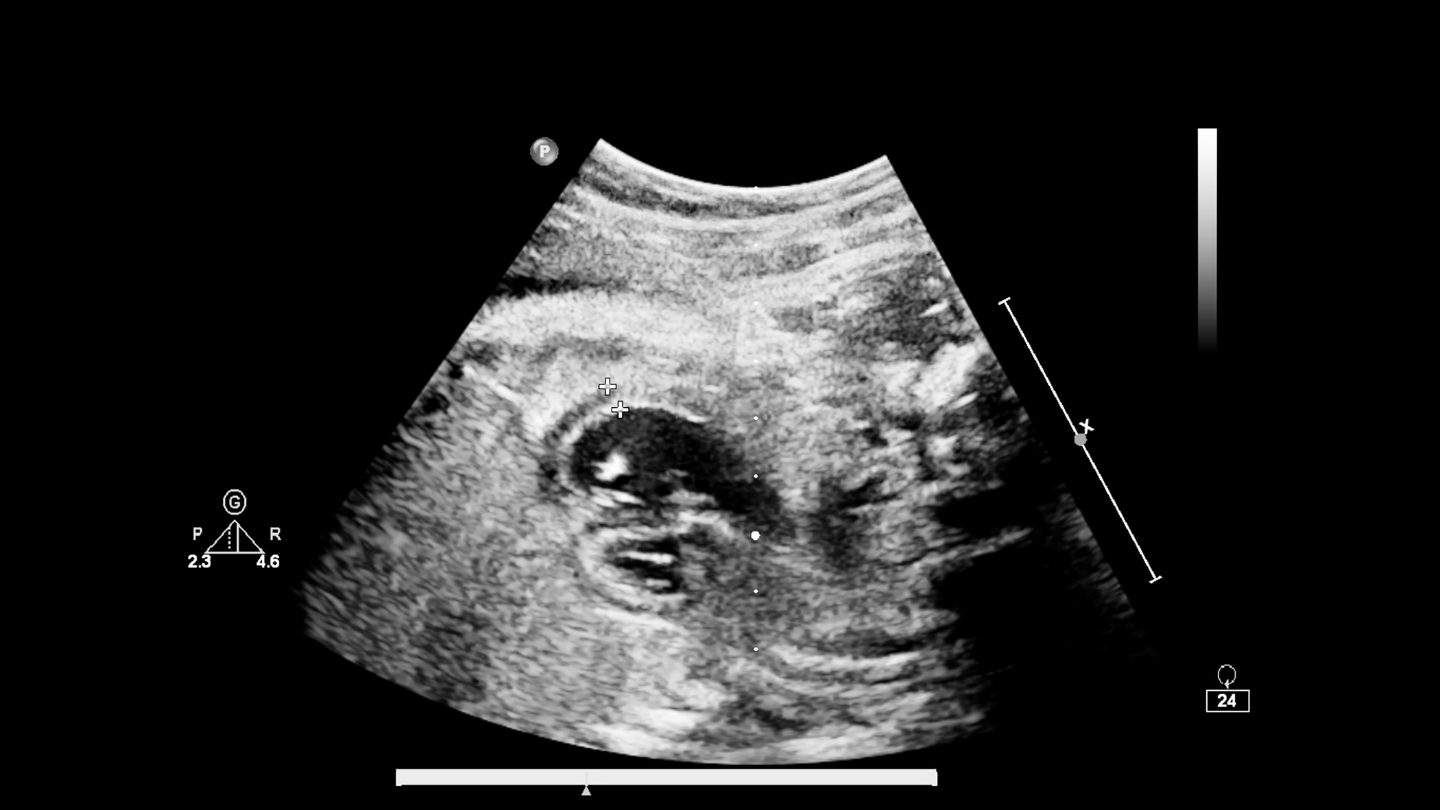 Siêu âm đầu dò cho hình ảnh có độ phân giải cao, giúp chẩn đoán chính xác hơn trong nhiều tình huống lâm sàng