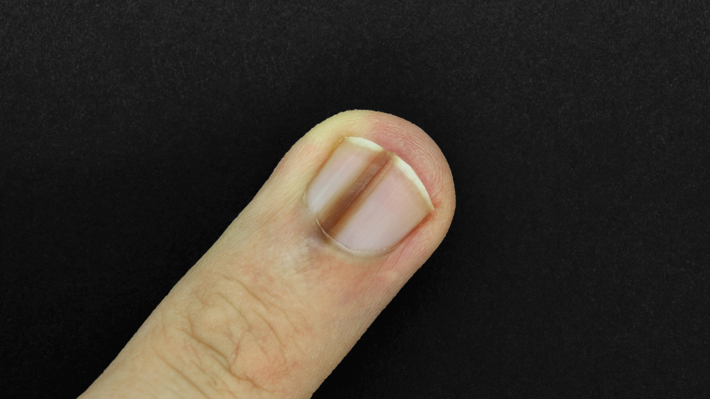 Không phải mọi trường hợp móng tay bị thâm đen đều là bệnh lý nguy hiểm