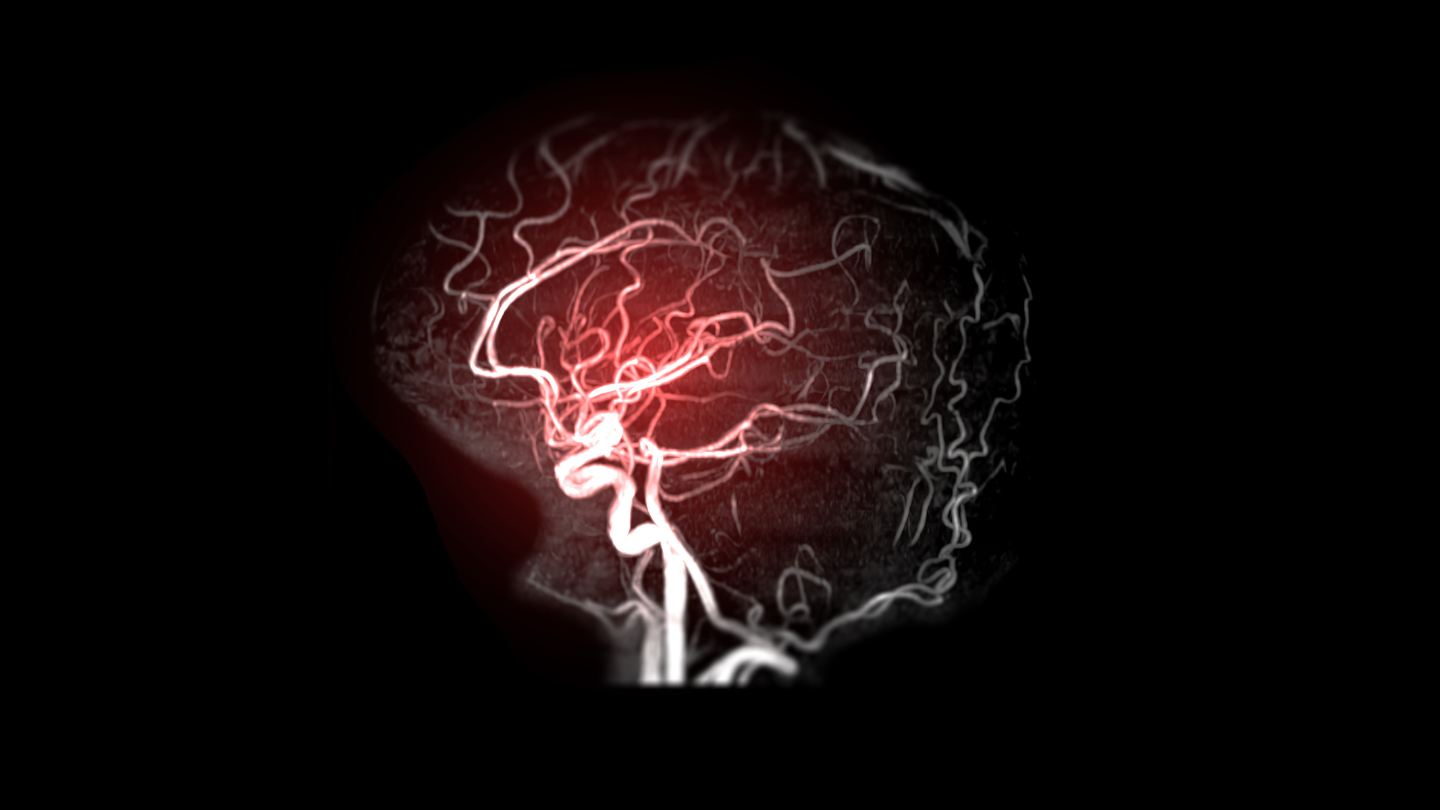 Thiếu máu lên não kéo dài có thể gây tổn thương não