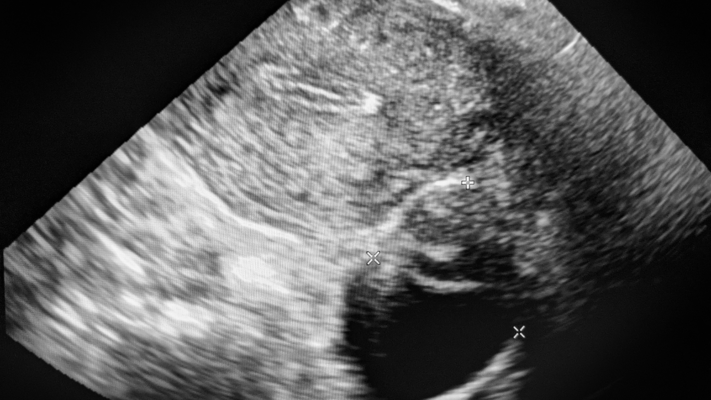 Hình ảnh siêu âm u nang buồng trứng