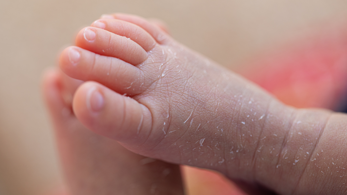 Giai đoạn bán cấp, viêm da cơ địa biểu hiện da khô, bong vảy nhẹ nhưng vẫn gây ngứa khó chịu