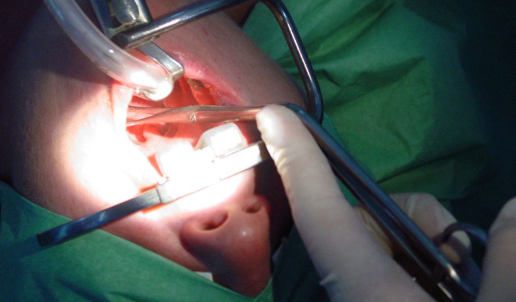 Phương pháp phẫu thuật quyết định mức độ đau, thời gian hồi phục và cả chi phí cắt amidan