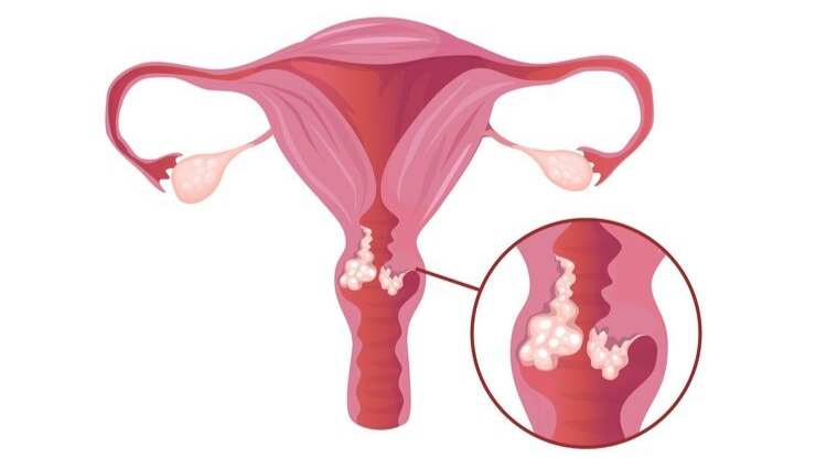 hinh-anh-ung-thu-co-tu-cung 2.jpg