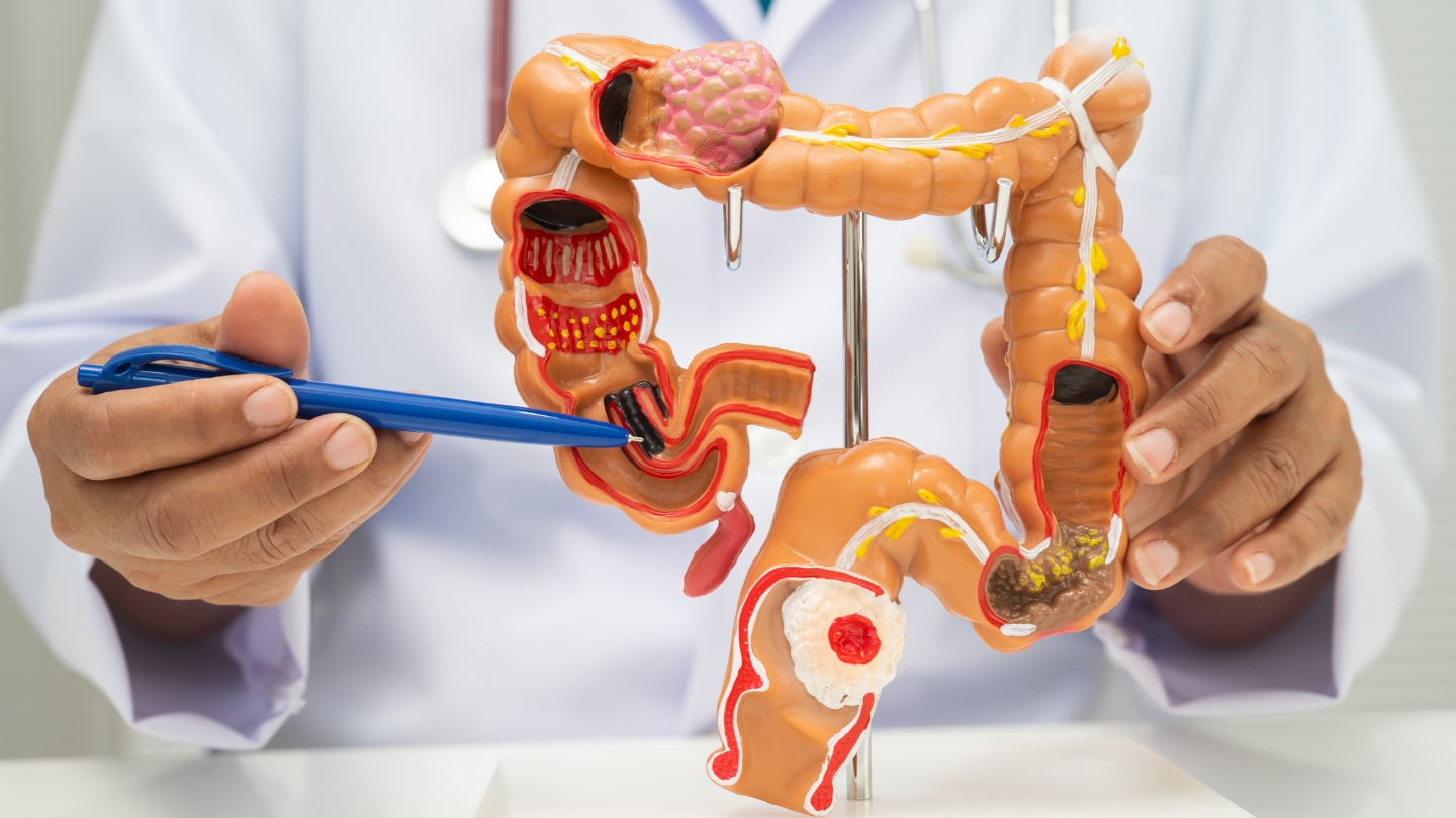 Polyp đại tràng có nguy cơ tiến triển thành ung thư