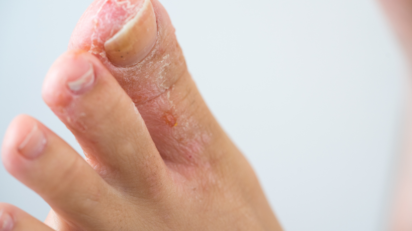 Nấm kẽ chân do nấm Trichophyton rubrum gây ra, thường khiến da bong tróc, đổi màu, nứt nẻ đau rát và có mùi khó chịu