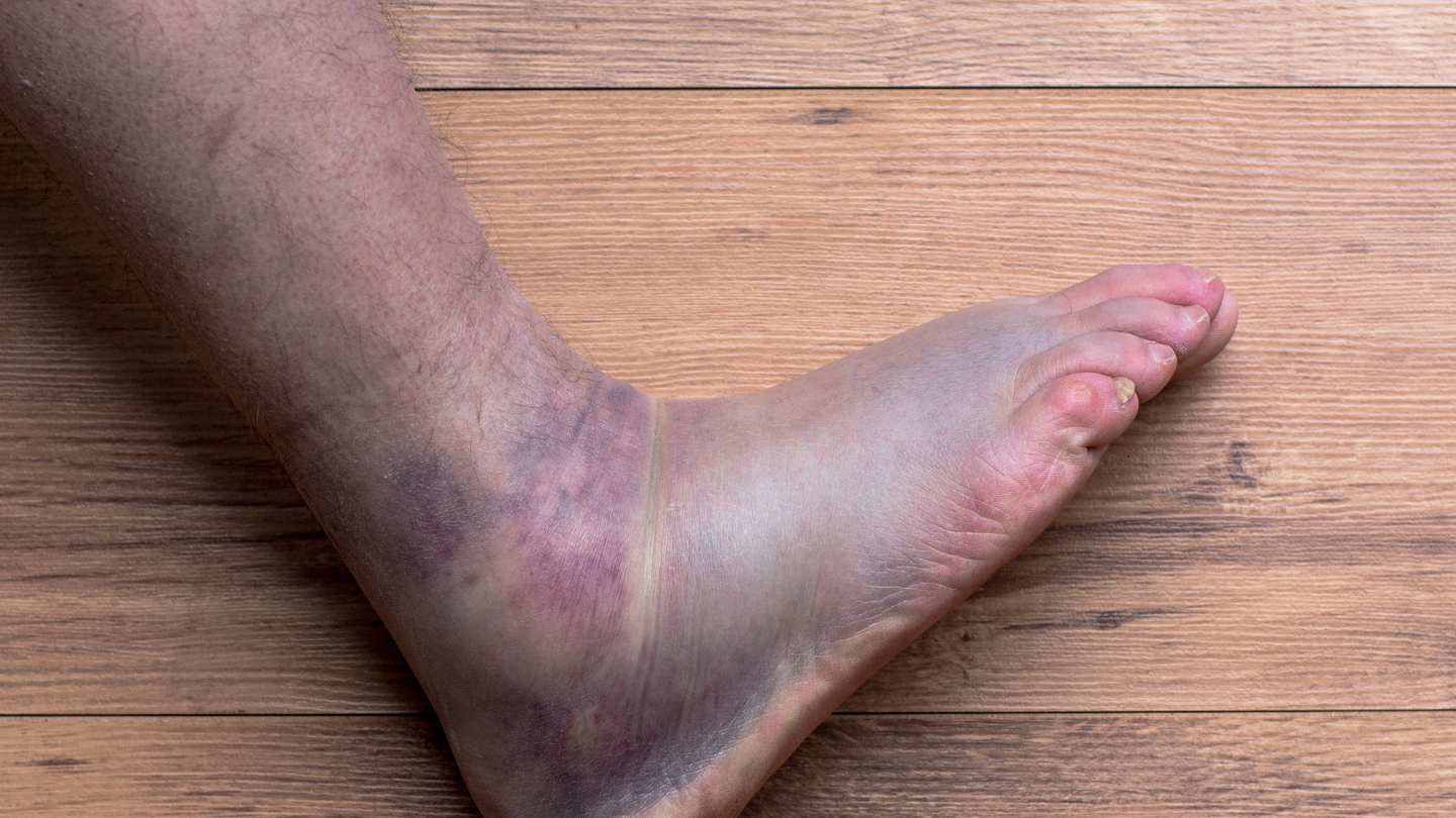 Chân sưng to, bầm tím và đau dữ dội khi bị gãy xương mắt cá