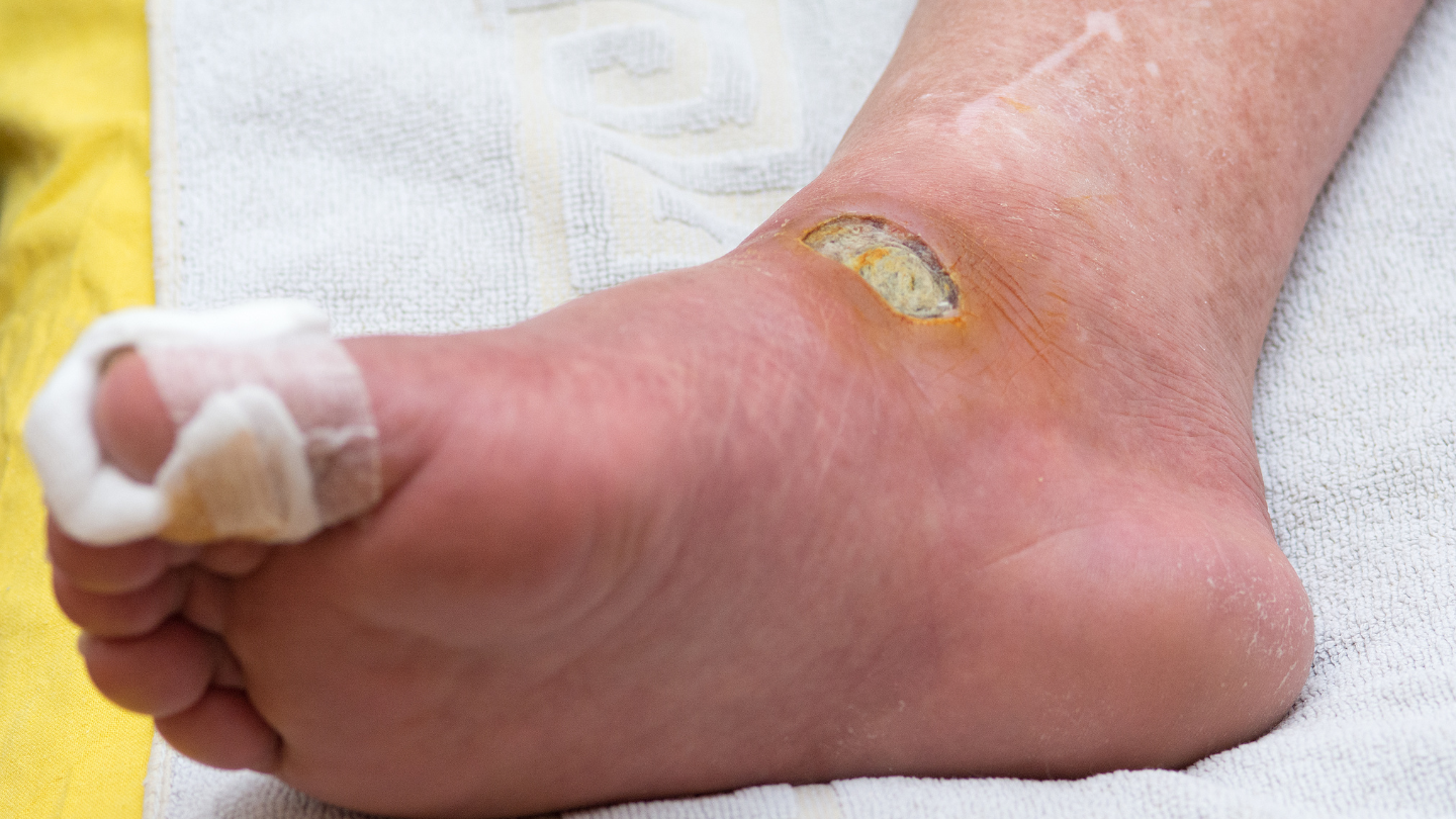 Loét bàn chân là một biến chứng nặng và nguy hiểm ở bệnh nhân đái tháo đường