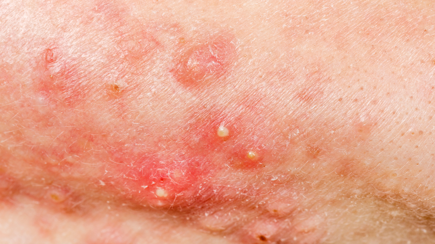 Cần thăm khám bác sĩ nếu mụn nhọt có dấu hiệu sưng, đỏ, viêm