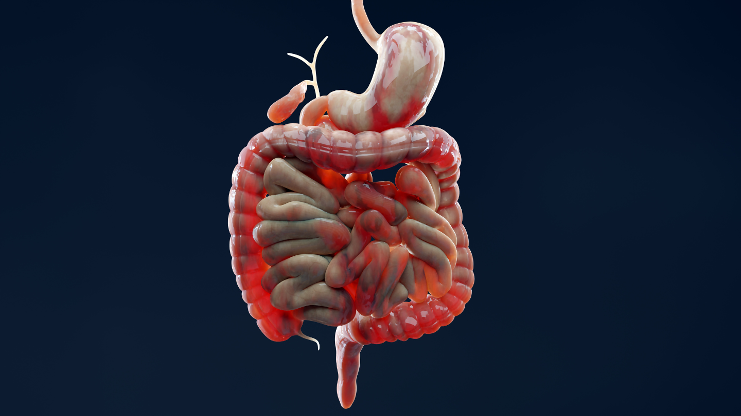 Người mắc bệnh Crohn thường có nguy cơ bị tắc ruột