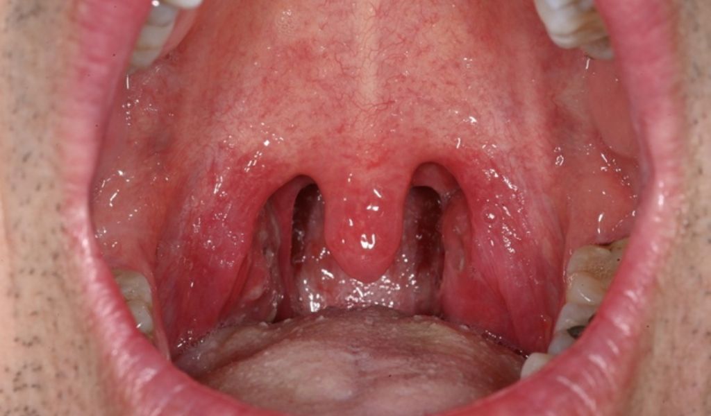 Hình ảnh viêm amidan cấp với amidan đỏ sưng