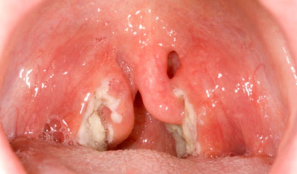 Hình ảnh amidan và vùng họng phủ mạc giả dày có màu trắng