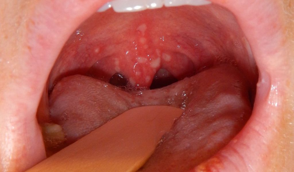 Hình ảnh minh họa viêm amidan mụn nước với các vết loét nông