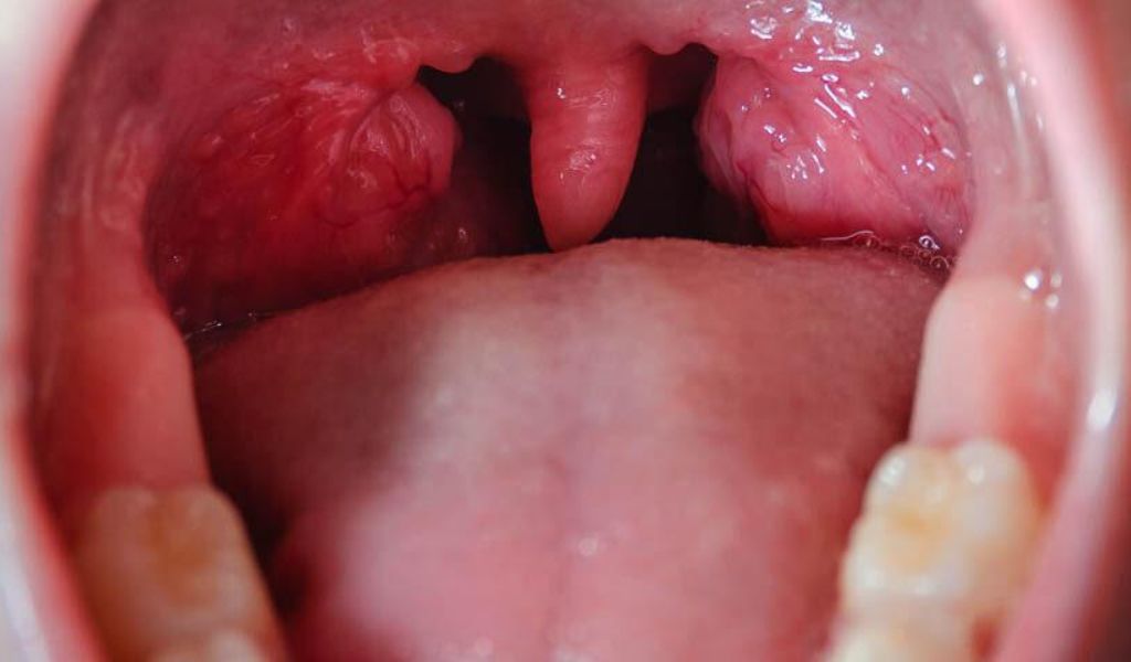 Hình ảnh minh họa viêm amidan mạn tính có xu hướng teo nhỏ và xơ hóa