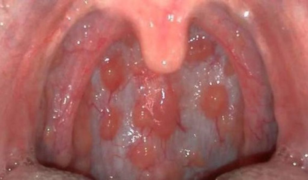 Hình ảnh amidan xuất hiện các hạt trắng cứng trong viêm amidan hạt