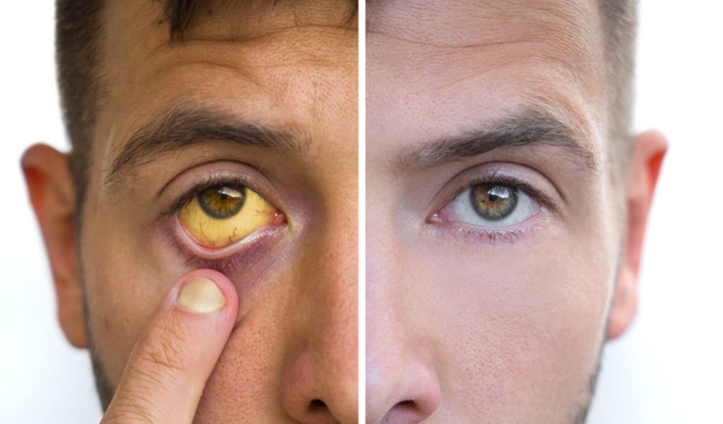 Hình ảnh minh họa triệu chứng vàng mắt, vàng da do suy giáp