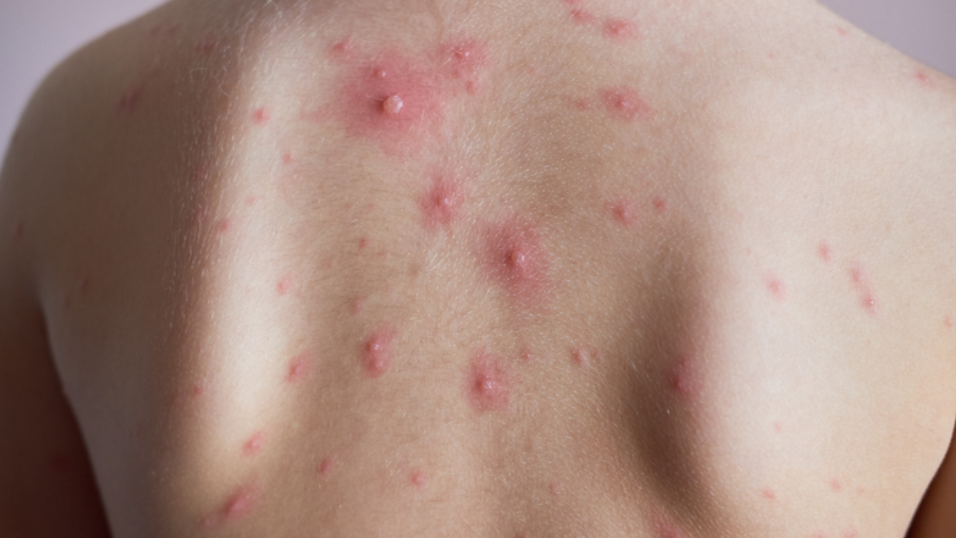 benh-thuy-dau-va-bien-hien-cua-not-thuy-dau-3