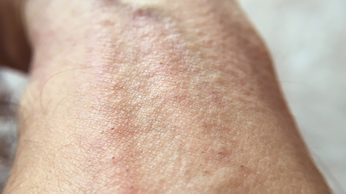 Các mảng da sậm màu, thô ráp do gãi nhiều, đây là đặc trưng của viêm da cơ địa mạn tính