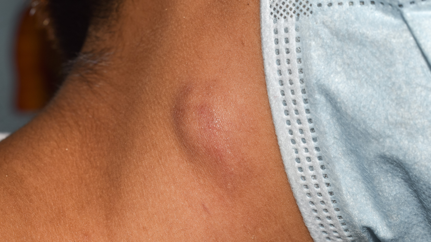 Tăng số lượng bạch cầu lympho có thể liên quan đến tình trạng sưng hạch bạch huyết