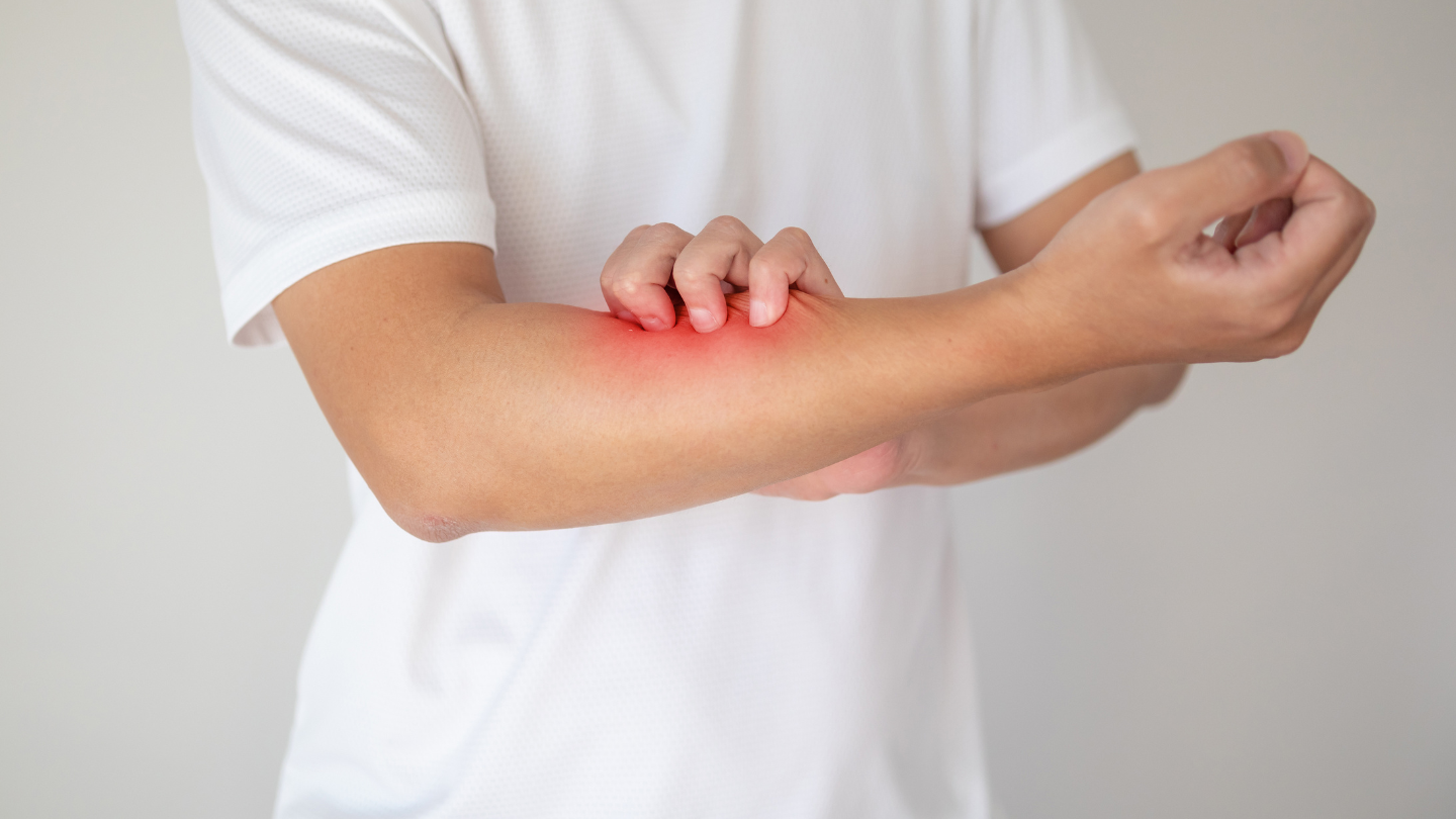 Không nên gãi hay làm vỡ bóng nước