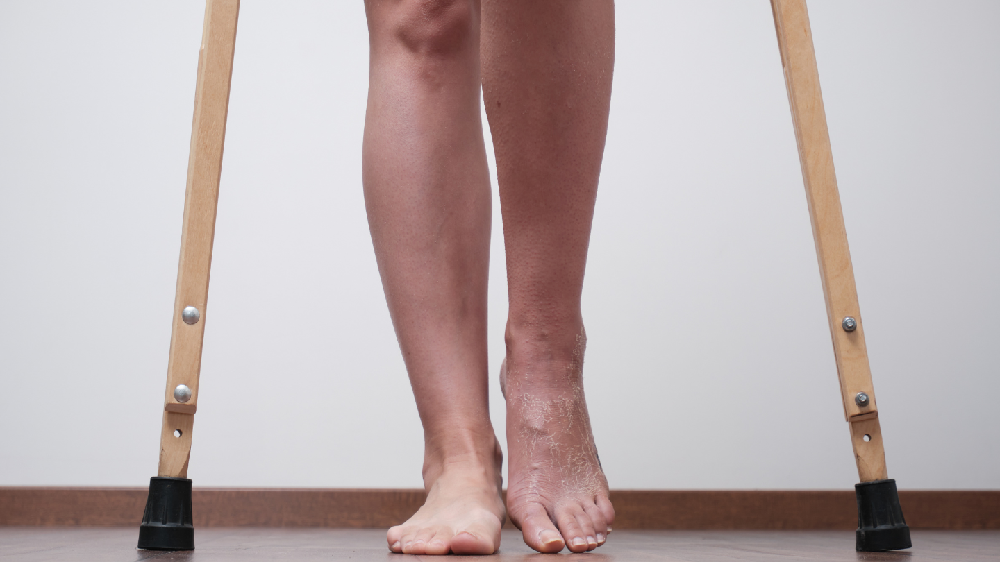 Tập đi lại sau gãy xương gót chân giúp phục hồi khả năng chịu lực và dáng đi bình thường