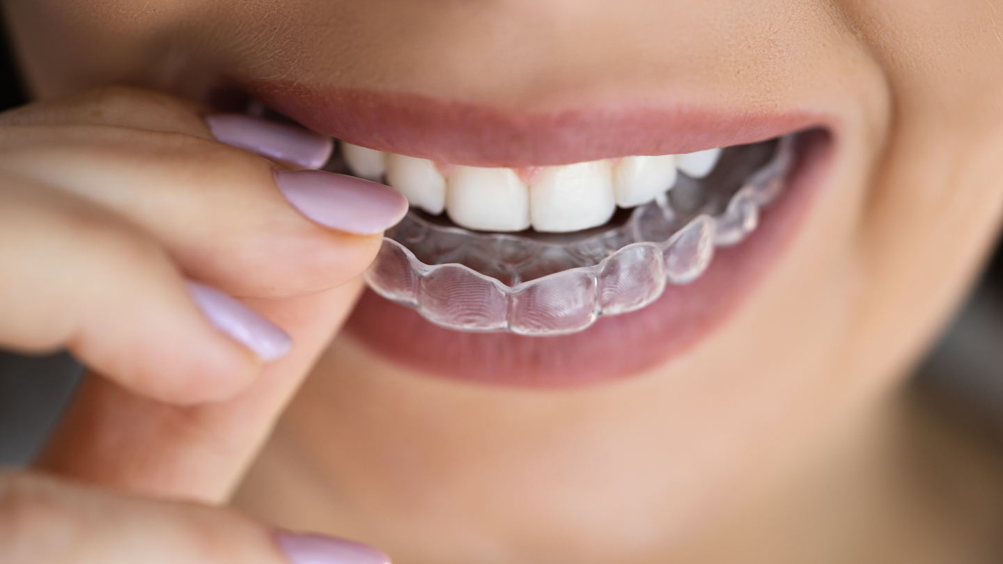 Niềng răng trong suốt ít gây cọ xát mô mềm so với niềng răng mắc cài truyền thống