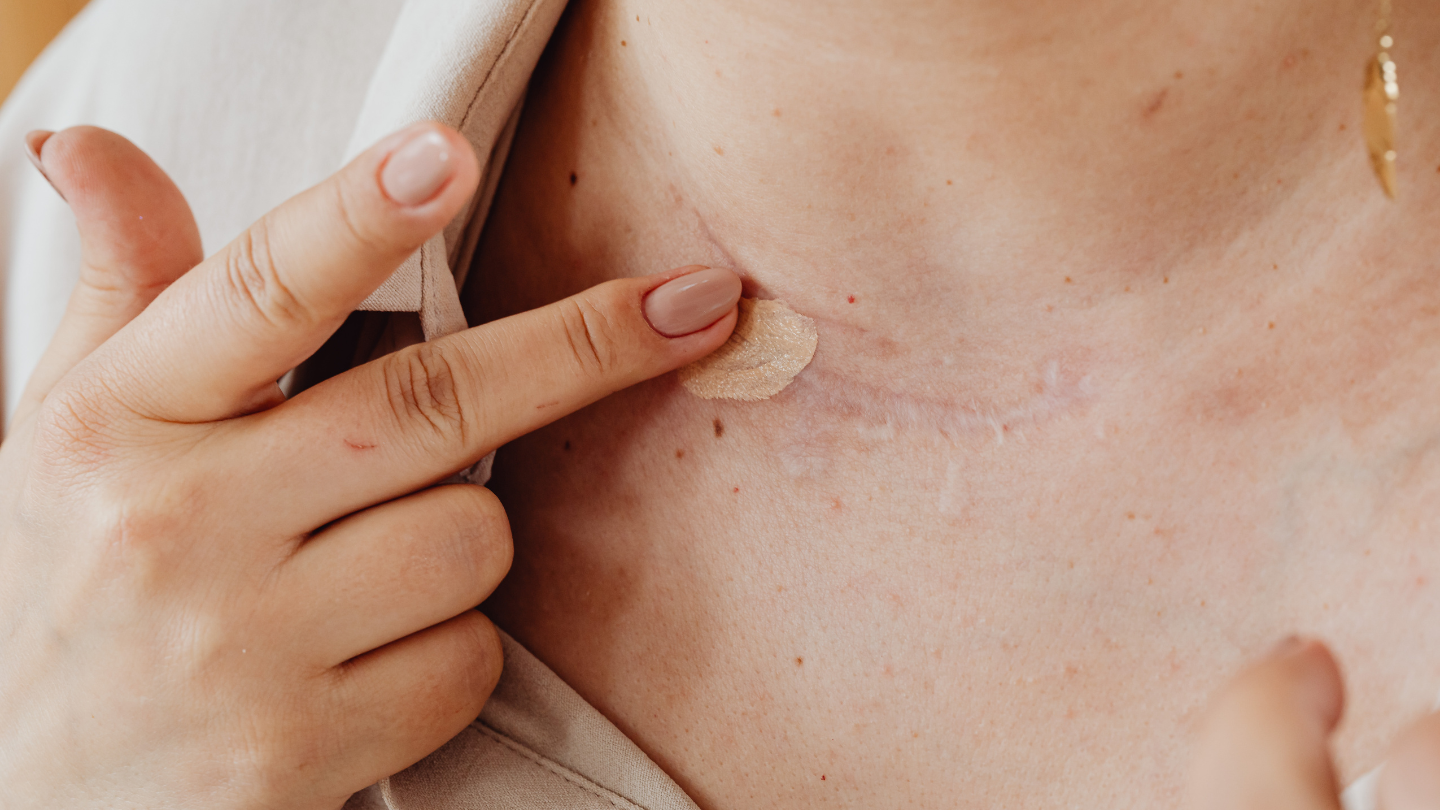 Có thể sử dụng kem dưỡng phù hợp tại vùng vết thương đã lành