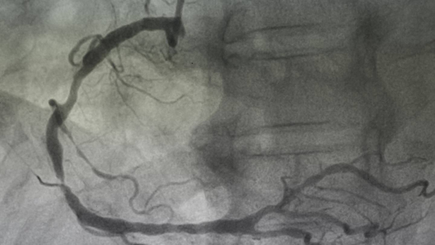 DSA là kỹ thuật chụp giúp thấy rõ mạch máu nhờ bơm thuốc cản quang và dùng máy chuyên dụng để hiện hình mạch