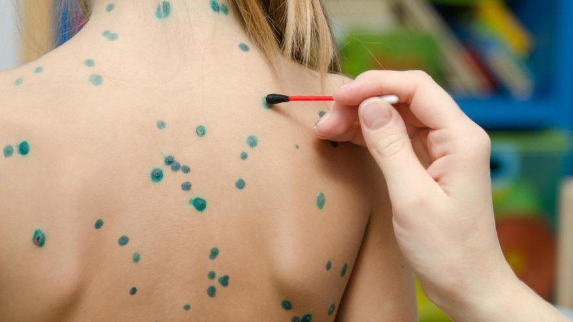 benh-thuy-dau-va-bien-hien-cua-not-thuy-dau-4