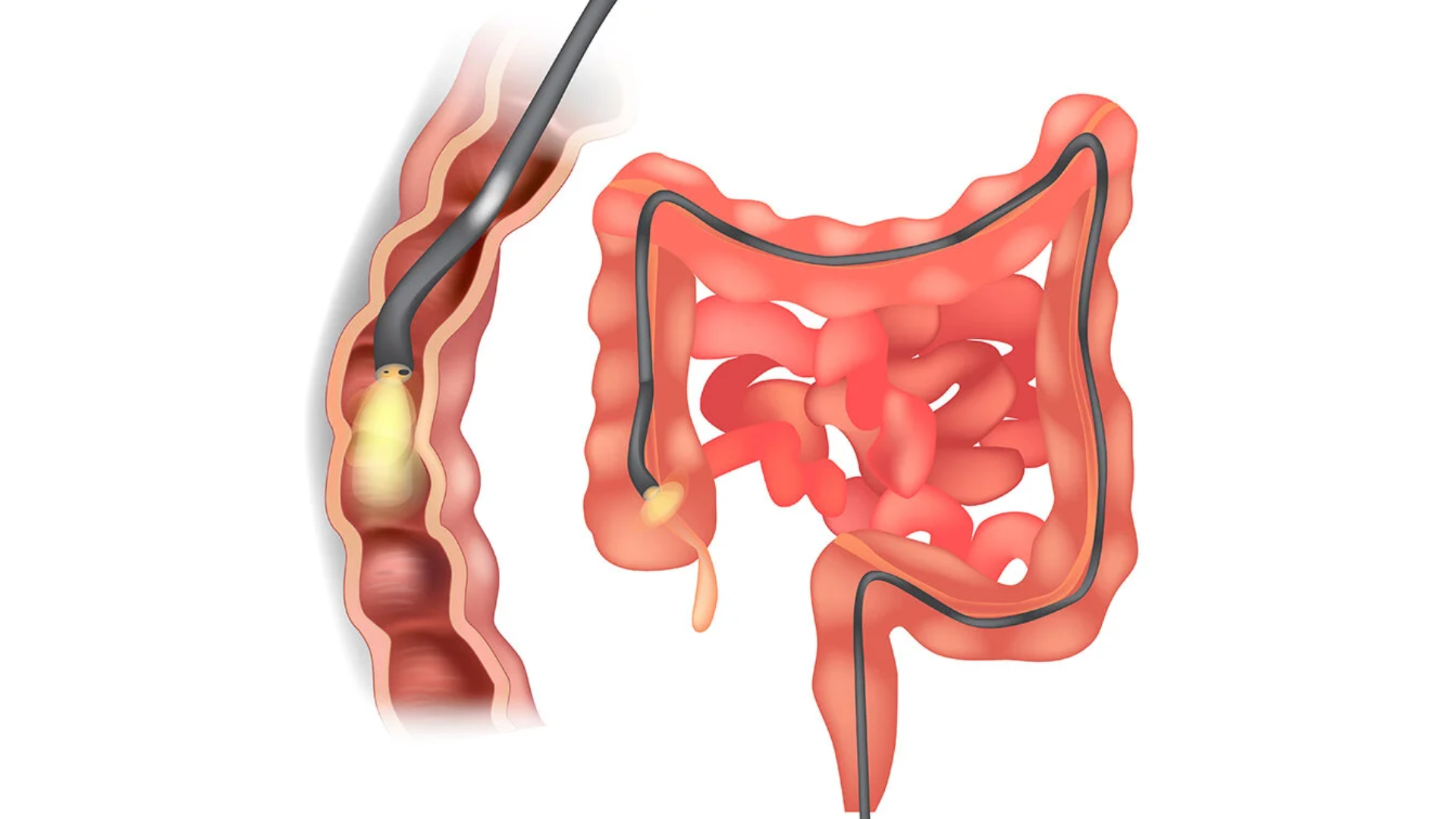 Bệnh Crohn đại tràng: Triệu chứng, phương pháp điều trị và phòng ngừa 4