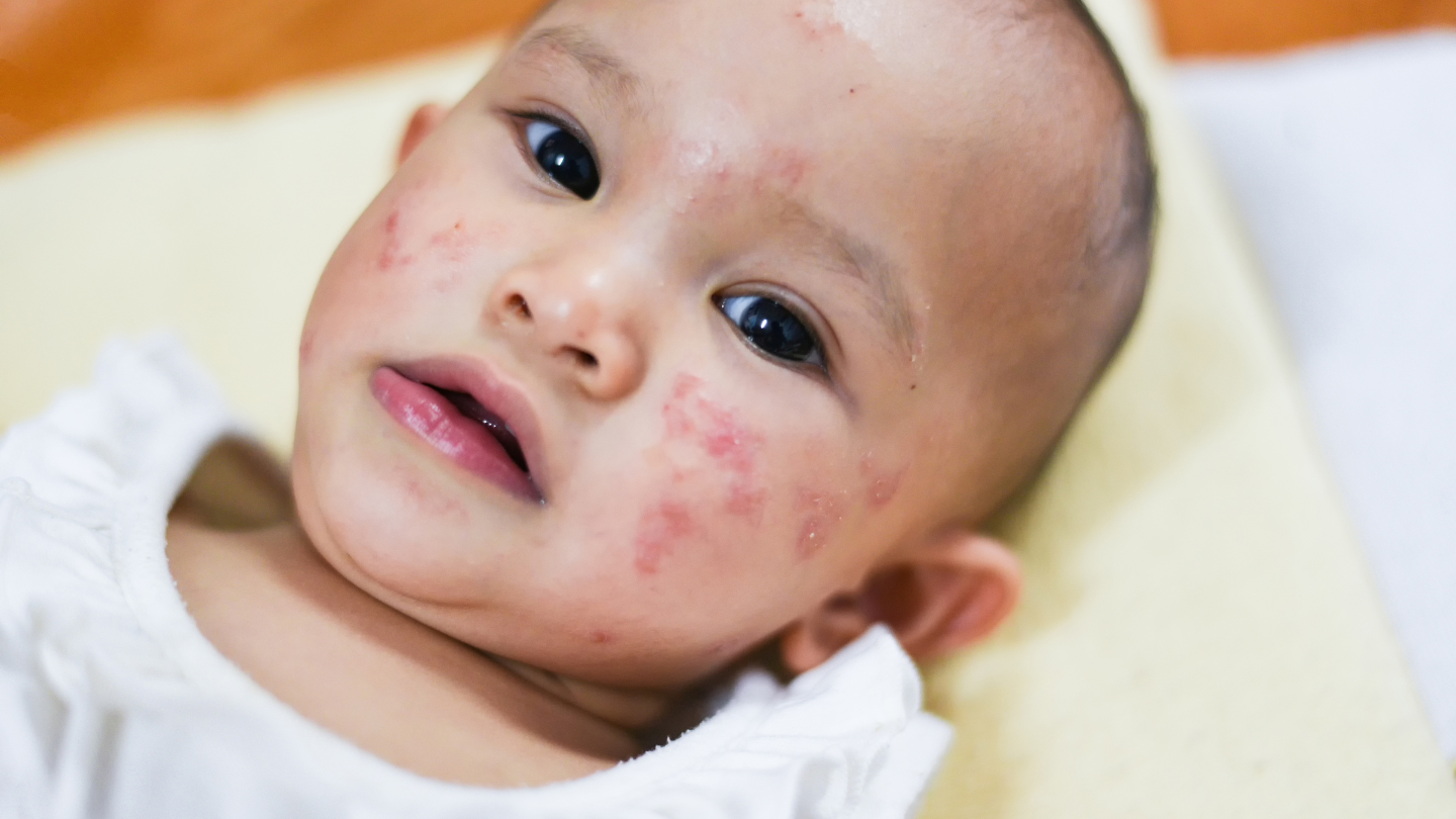 Hệ miễn dịch phản ứng quá mức với dị nguyên như bụi, phấn hoa có thể gây bùng phát viêm da ở trẻ