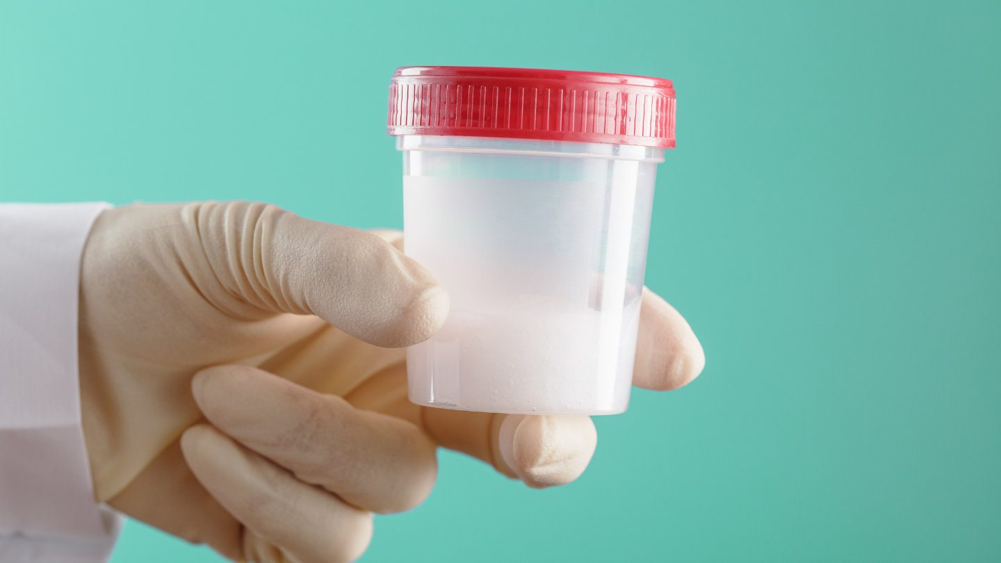 Giá trị bình thường đối với thể tích tinh dịch là từ 1,4 ml trở lên