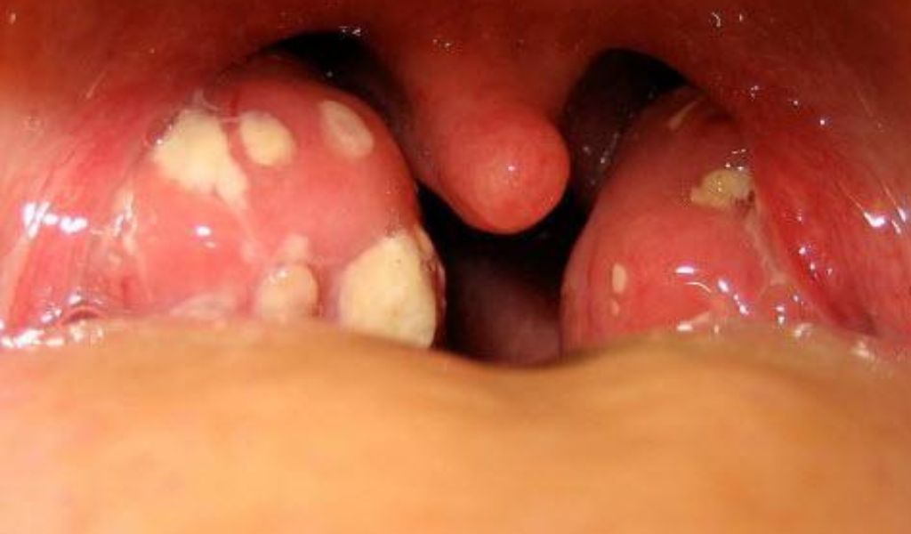 Amidan viêm kéo dài khiến nhiều người băn khoăn rằng cắt amidan có đau không?